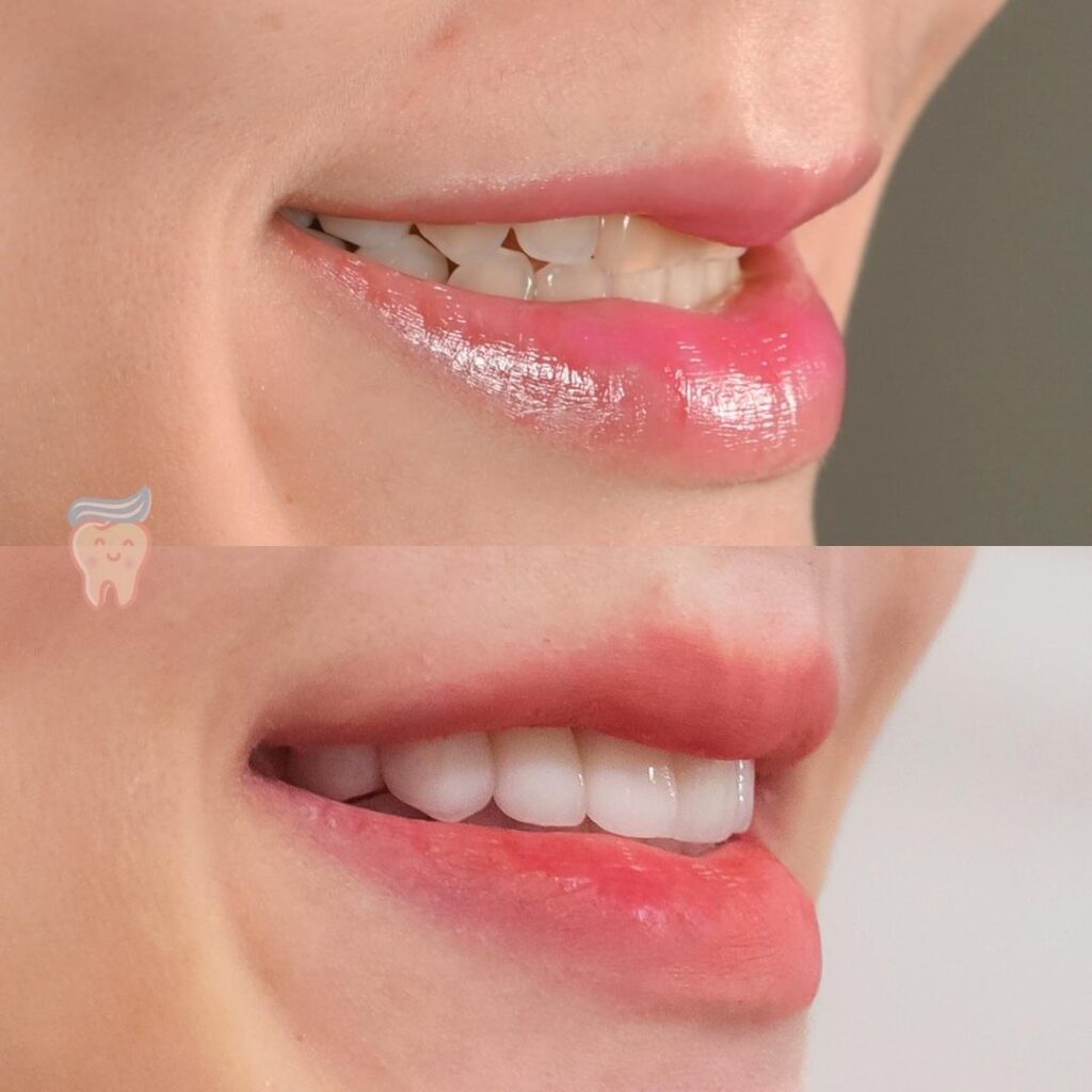 วีเนียร์