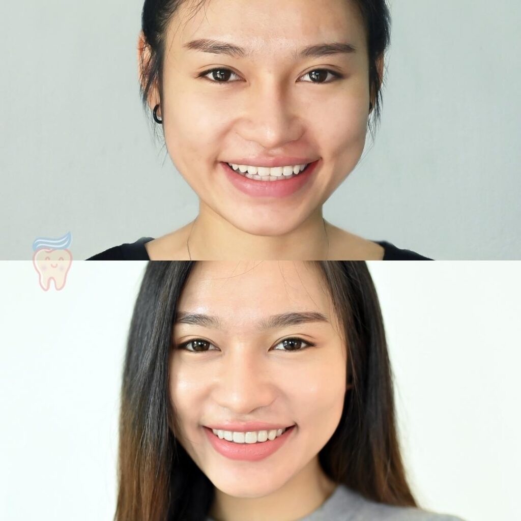 วีเนียร์